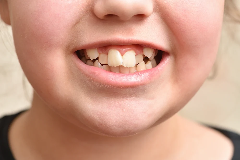 Anomalías dentales en niños
