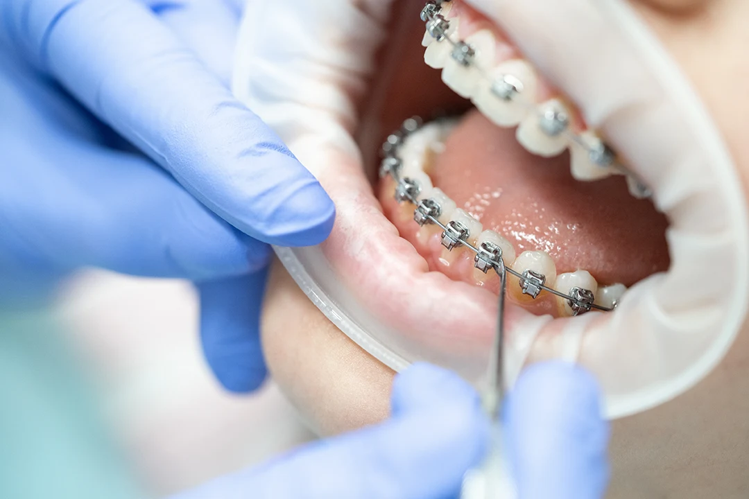 Ortodoncia con brackets
