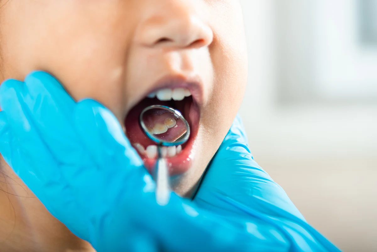 Tratamientos dentales para niños