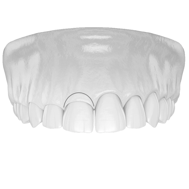 Gingivectomía